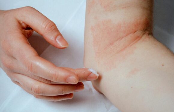 Decoding Eczema: Understanding the Causes, Symptoms, and Impact on Everyday Life