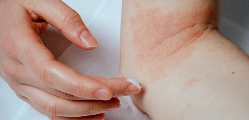 Decoding Eczema: Understanding the Causes, Symptoms, and Impact on Everyday Life