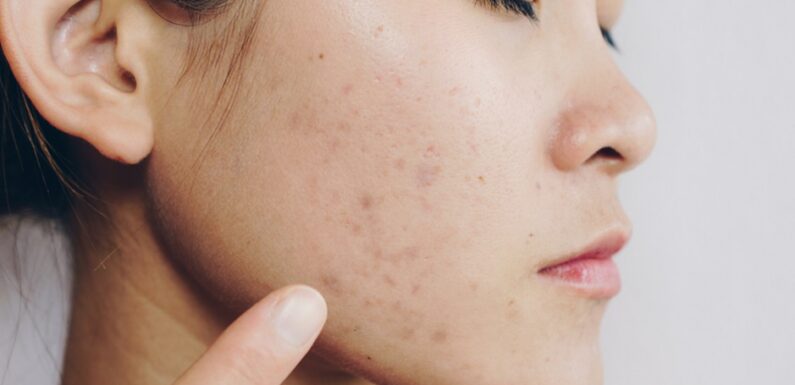 The Path to Clear Skin: Ways to Remove Acne Scars