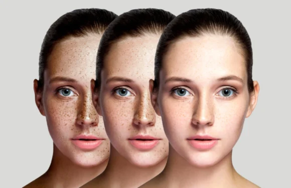 What are the long-term results of pigmentation removal treatments and how can I maintain my results?