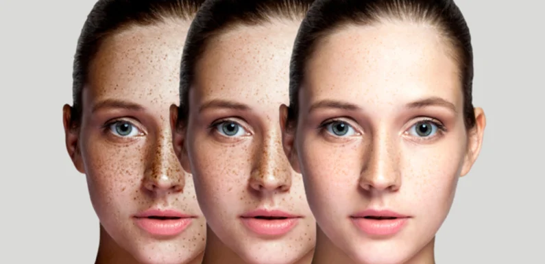 What are the long-term results of pigmentation removal treatments and how can I maintain my results?