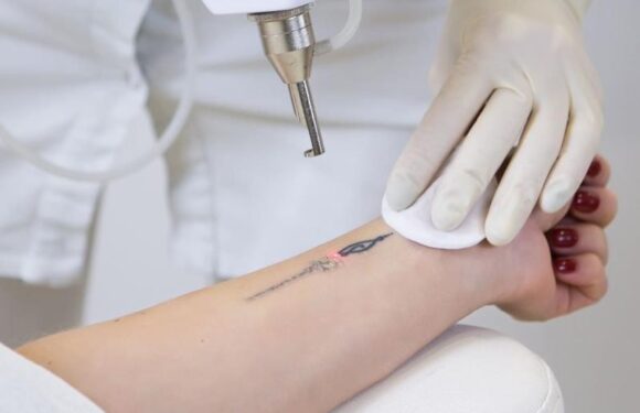 Tattoo Removal Techniques: From Laser to Non-Laser Options