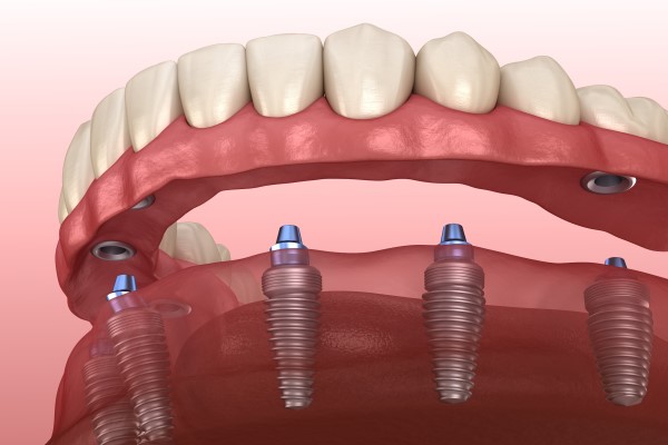 dental implants