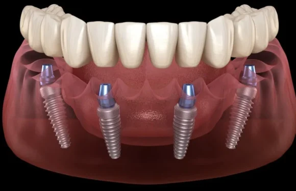 Affordable dental implants in Jurong: Tips to Manage the Costs