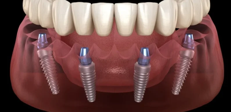 Affordable dental implants in Jurong: Tips to Manage the Costs