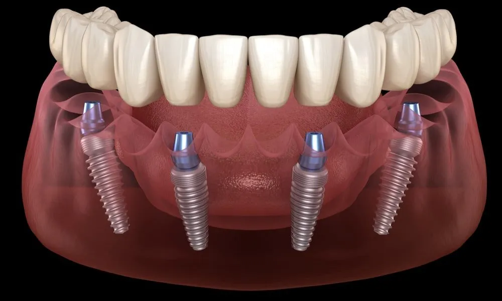 dental implants
