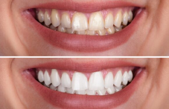 Before and After Teeth Whitening: The Results Will Blow Your Mind