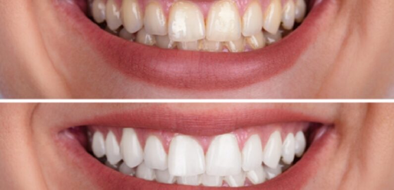 Before and After Teeth Whitening: The Results Will Blow Your Mind