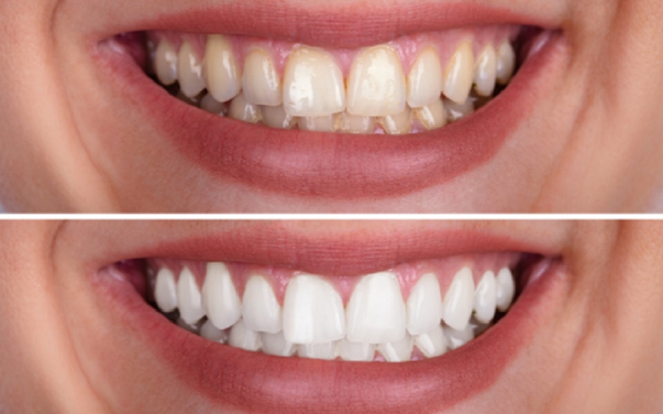 Before and After Teeth Whitening