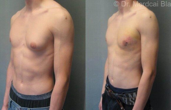 Understanding Man Boobs: Causes, Types, and Treatment Options