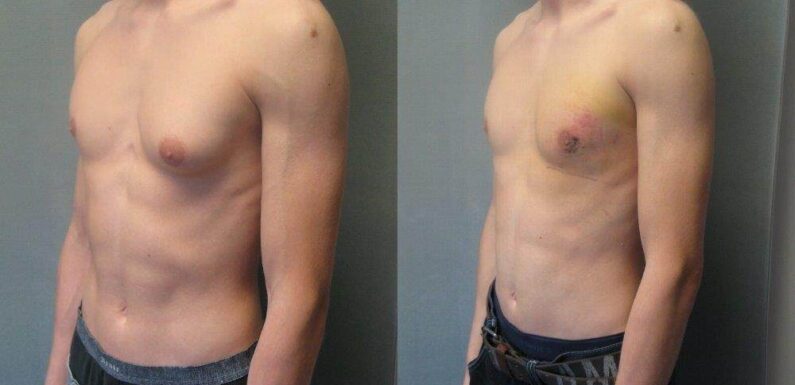 Understanding Man Boobs: Causes, Types, and Treatment Options