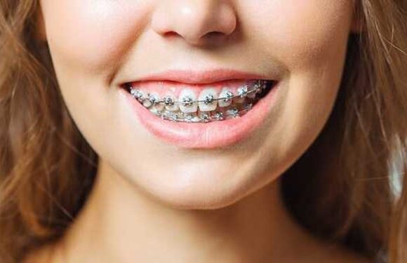 How Local Climate Impacts Orthodontic Care: A Deep Dive into Braces in Minot, ND